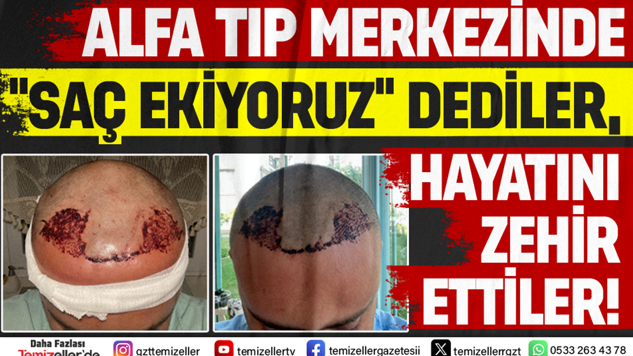 ALFA TIP MERKEZİ’NDE “SAÇ EKİYORUZ” DEDİLER, HAYATI ZEHİR ETTİLER!
